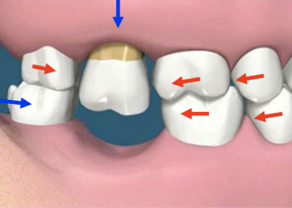 Pourquoi faut-il remplacer les dents manquantes ?