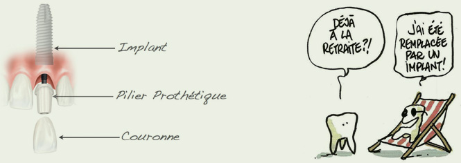 pose implant dentaire
